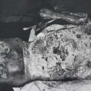 The burned back of an atomic bomb victim.
